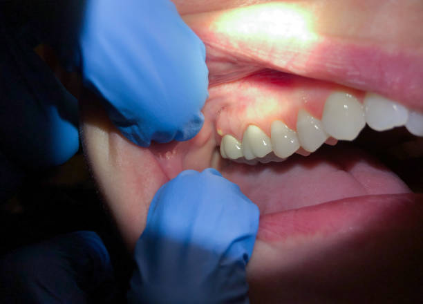 Best Same-Day Emergency Dentist in Scottsburg, IN