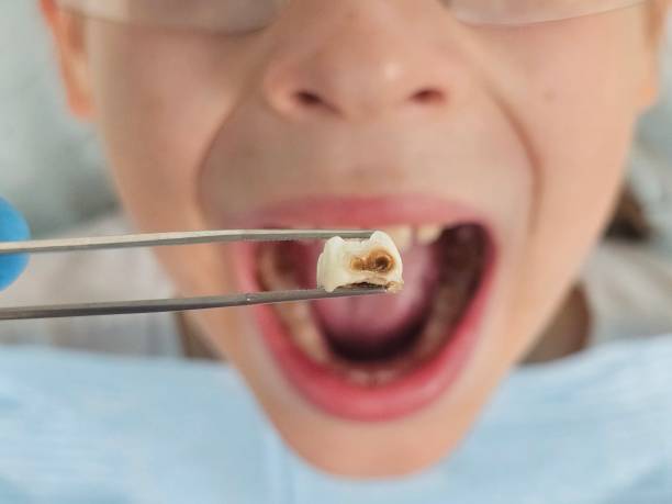 Best Emergency Tooth Extraction in Scottsburg, IN